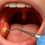 Extreme Prevention: How to Stop Tonsil Stones Before They Get Out of Control