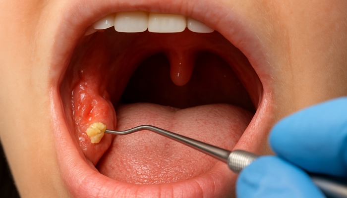 You are currently viewing Extreme Prevention: How to Stop Tonsil Stones Before They Get Out of Control