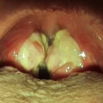 Rare Throat Bacteria You Should Know