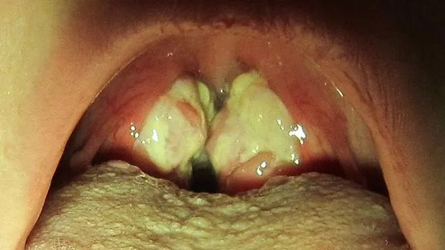 You are currently viewing Rare Throat Bacteria You Should Know