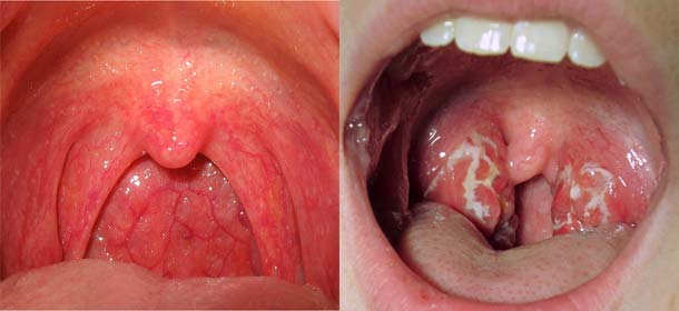 Read more about the article When a Sore Throat Becomes Serious: When to See a Doctor