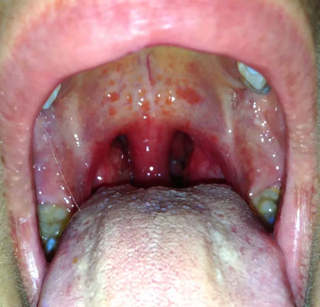 Read more about the article Long-Term Strep Complications: What You Need to Know