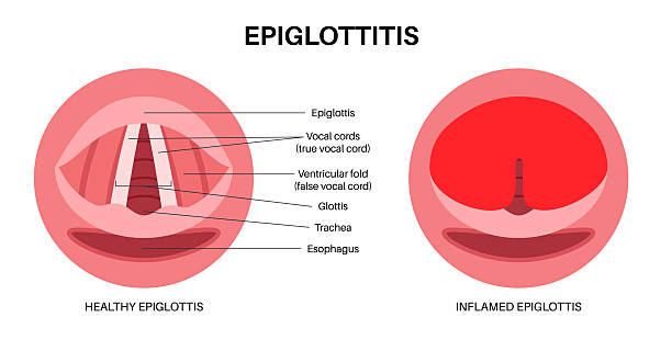 Read more about the article Rising Epiglottitis Rates in Eastern China: What the 2024 Study Reveals About Seasonal Patterns
