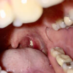 Extreme Tonsil Stones: When a Tiny Lump Becomes a Medical Nightmare