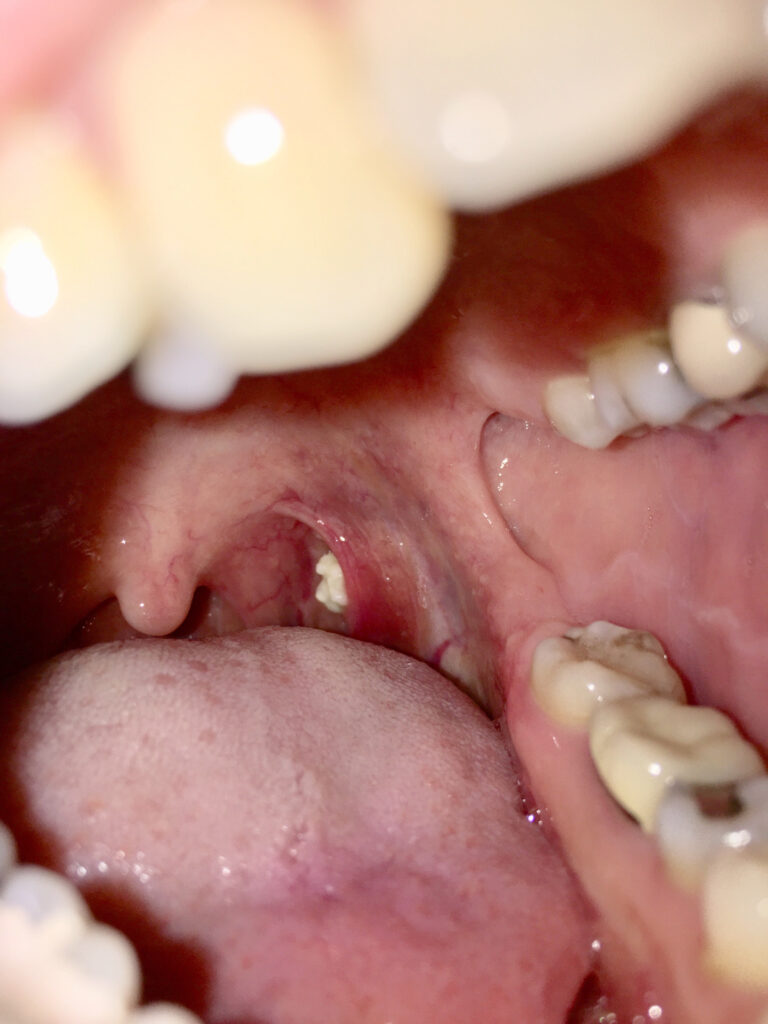Read more about the article Extreme Tonsil Stones: When a Tiny Lump Becomes a Medical Nightmare