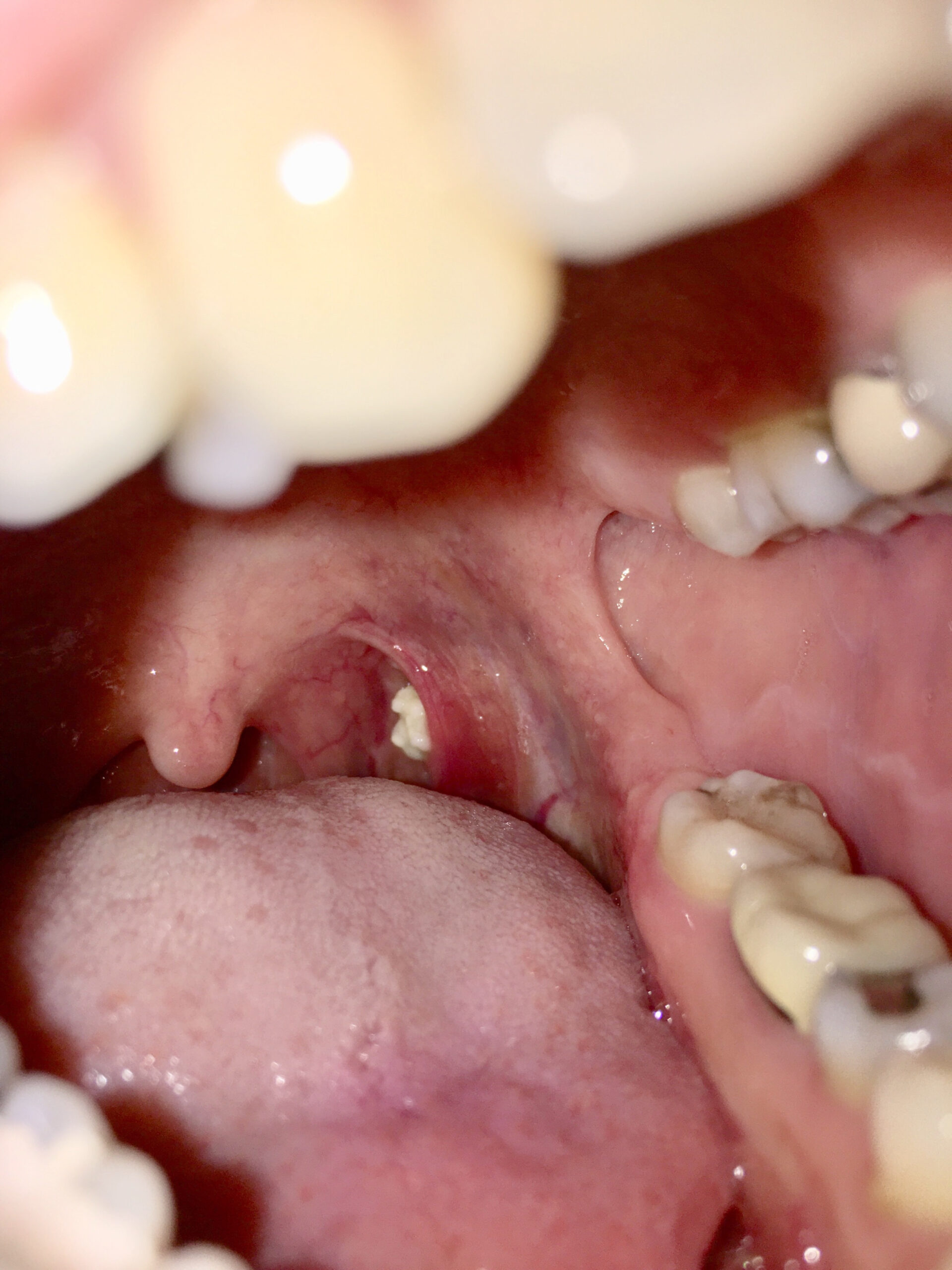 Read more about the article Extreme Tonsil Stones: When a Tiny Lump Becomes a Medical Nightmare