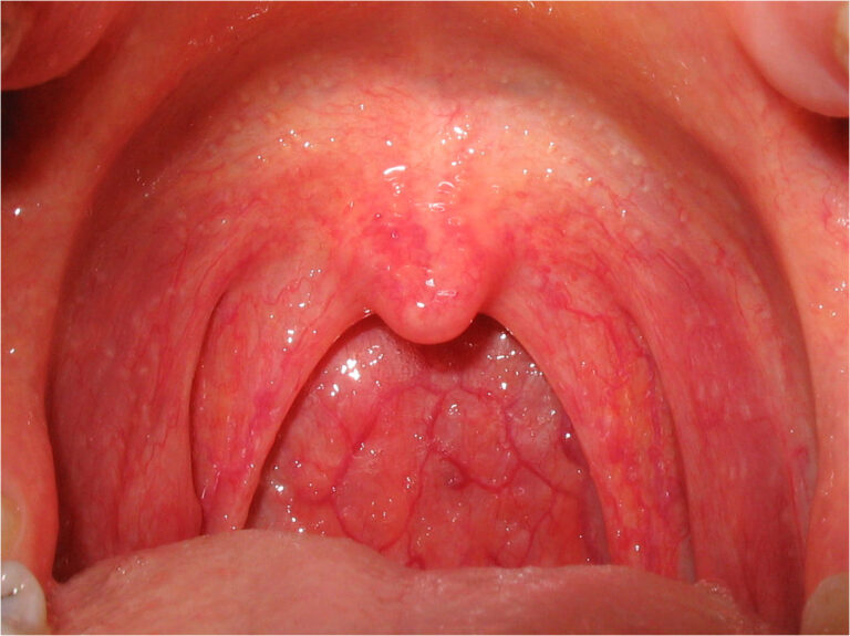 Read more about the article What Causes a Sore Throat? A Simple Guide for Readers