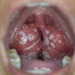 When to Panic: 7 Warning Signs Your Tonsil Stone Is Dangerous