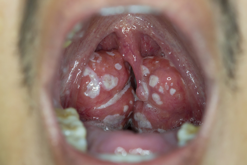 You are currently viewing When to Panic: 7 Warning Signs Your Tonsil Stone Is Dangerous