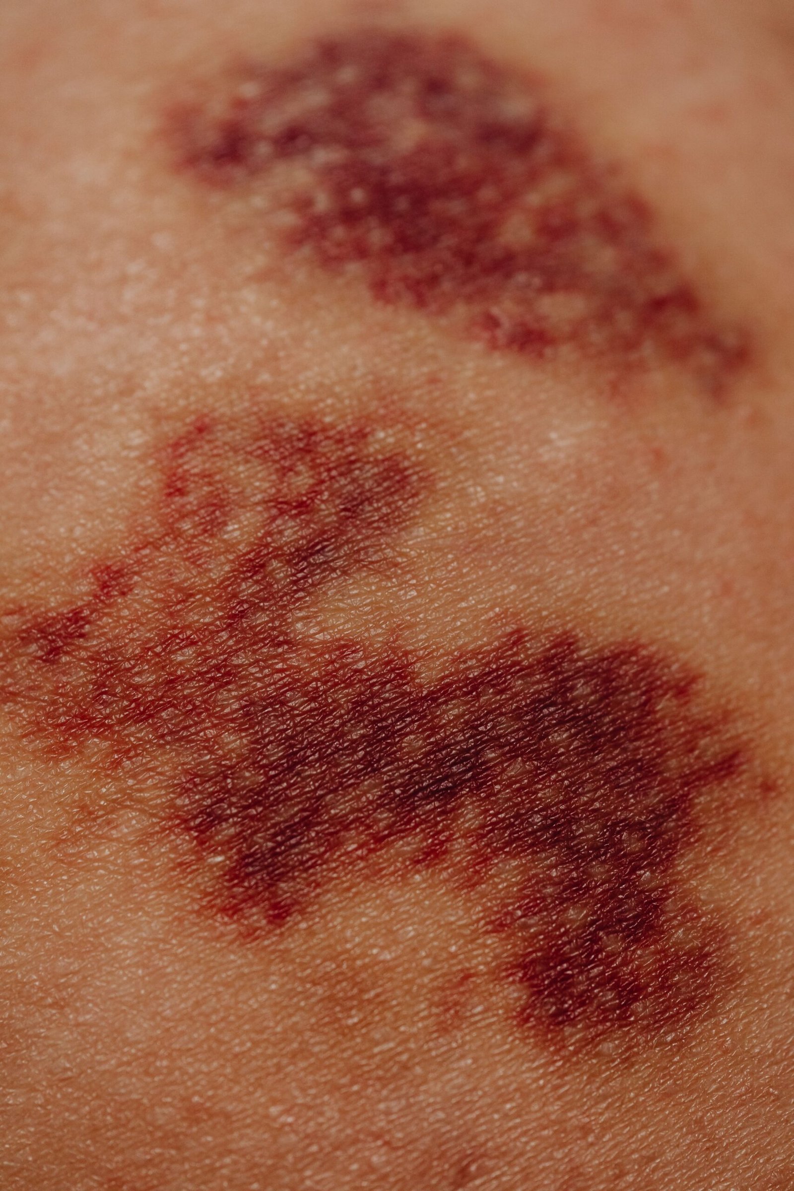 You are currently viewing Why 50,000 Swedes Struggle with Slow-Healing Wounds: The Hidden National Health Crisis