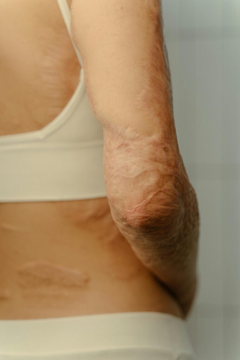 Read more about the article Swedish Breakthrough: How Body’s Own Cells Are Accelerating Chronic Wound Healing