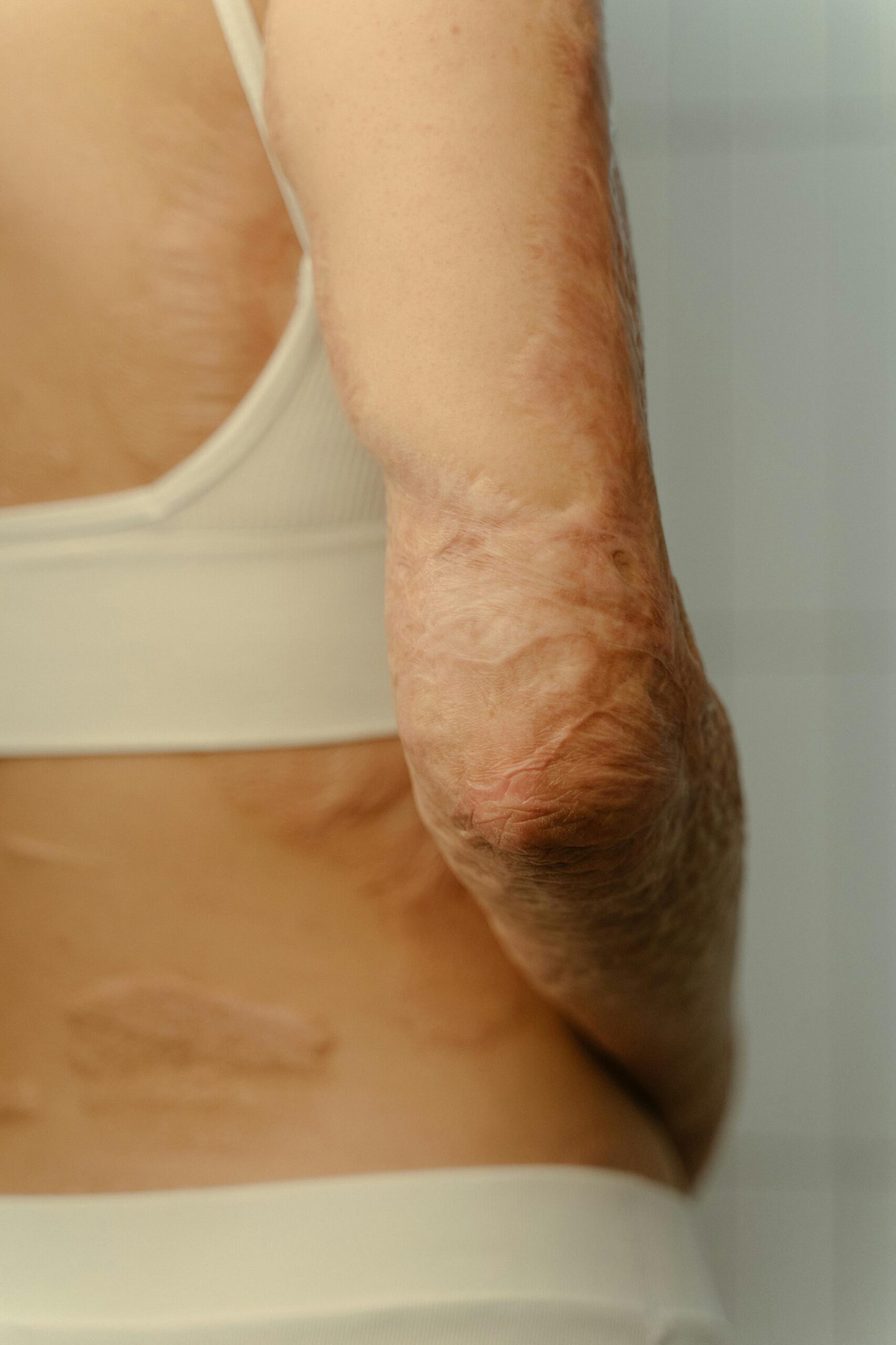 Read more about the article Swedish Breakthrough: How Body’s Own Cells Are Accelerating Chronic Wound Healing